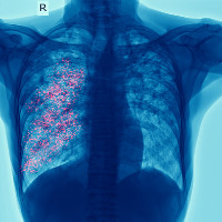 die Tuberkulose