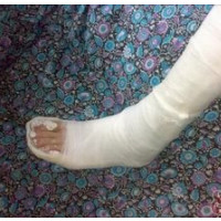 der Gipsverband