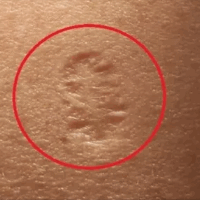 die Pocken